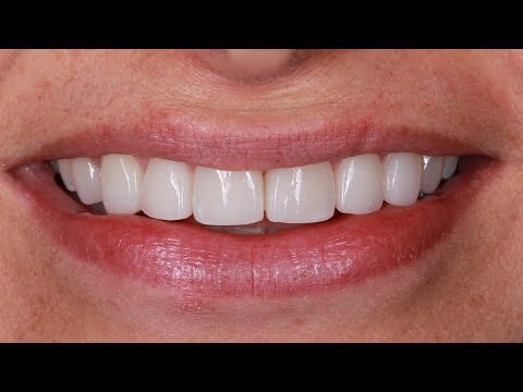 Qual o Preço de Implante Dentário no Brasil? Valores das Populares e Mais Caras