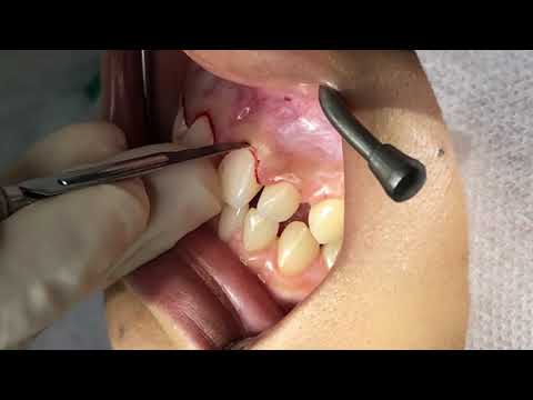 Cirurgia periodontal para tratamento do sorriso gengival