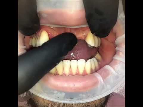 Perdi os 4 Dentes da frente, o que fazer ??? - FABRICIO IMPLANTES - ARUJÁ - SP