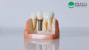 Implante dentário preço popular