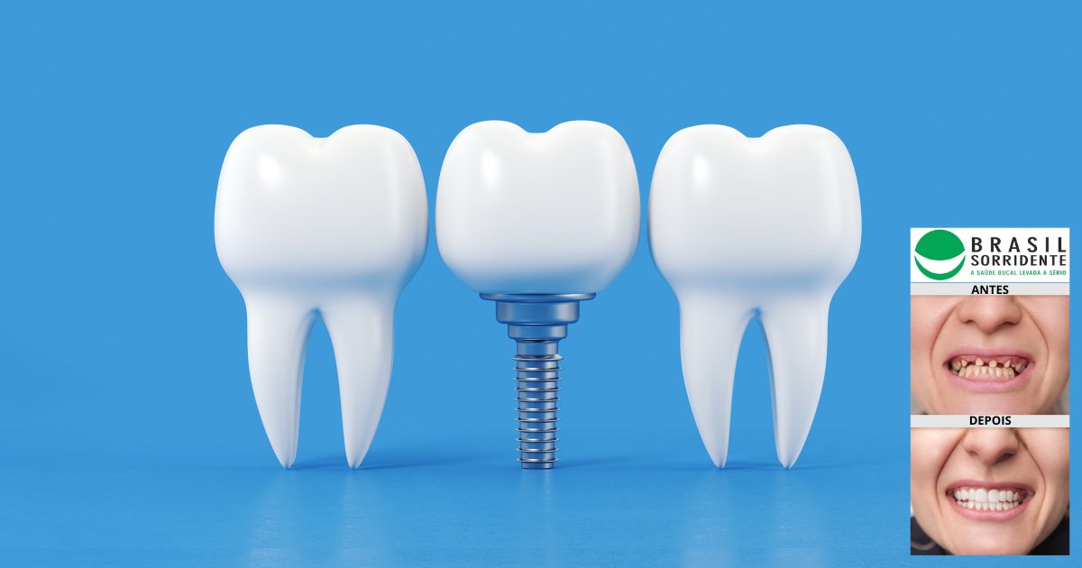 Implante dentário pelo sus 2024